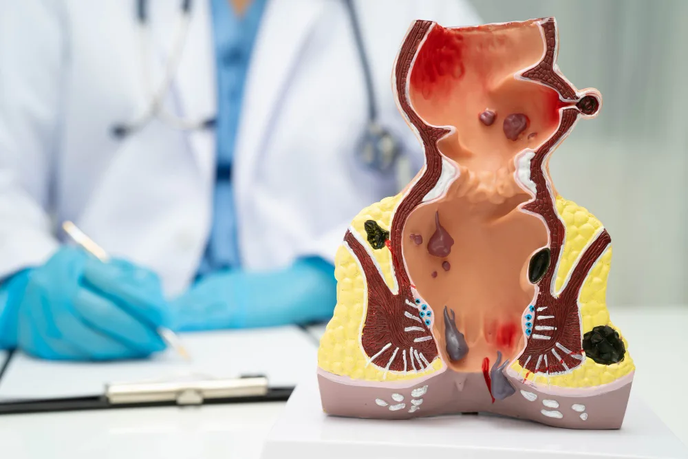 Absceso anal