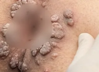 Condilomatosis anal por VPH