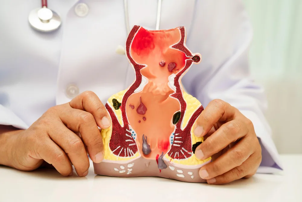Fistula anal con pus o sin pus