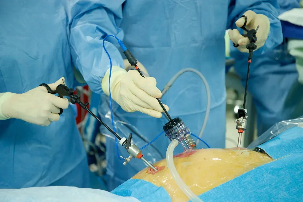 Reparación de ileostomía y colostomía en Querétaro: valorar si el estoma puede cerrarse
